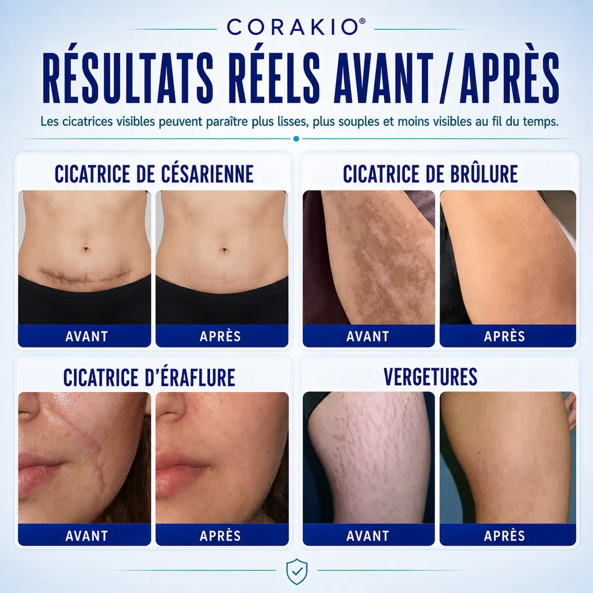 🆙✨corakio® Gel Avancé au Silicone pour Cicatrices – Crème Professionnelle Anti-Cicatrices pour Cicatrices Chirurgicales, Chéloïdes, Vergetures, Cicatrices de Césarienne & Réparation des Cicatrices Anciennes ou Récentes