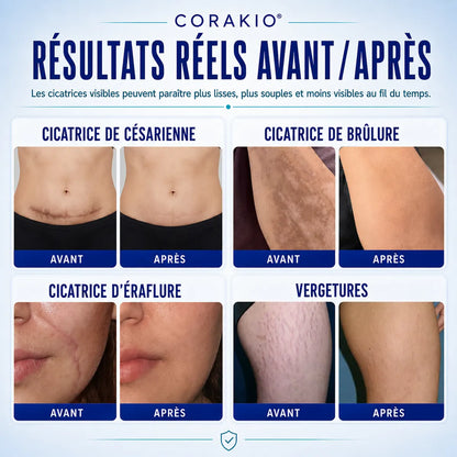 🆙✨corakio® Gel Avancé au Silicone pour Cicatrices – Crème Professionnelle Anti-Cicatrices pour Cicatrices Chirurgicales, Chéloïdes, Vergetures, Cicatrices de Césarienne & Réparation des Cicatrices Anciennes ou Récentes