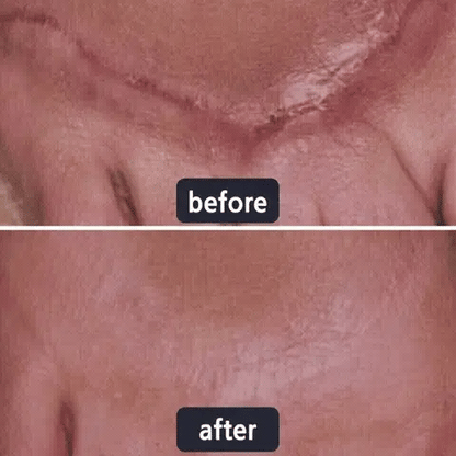 🆙✨corakio® Gel Avancé au Silicone pour Cicatrices – Crème Professionnelle Anti-Cicatrices pour Cicatrices Chirurgicales, Chéloïdes, Vergetures, Cicatrices de Césarienne & Réparation des Cicatrices Anciennes ou Récentes