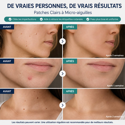 Effective MicroNeedle BotanicSkinTag Removal Patch