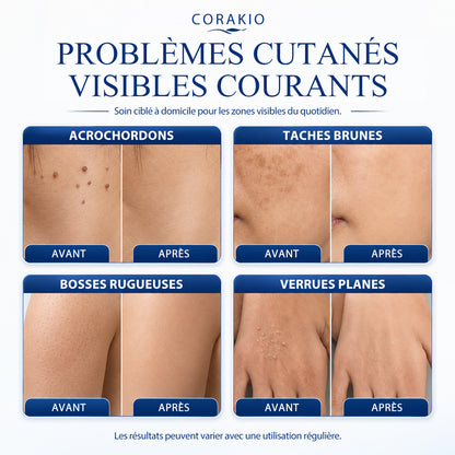 𝟕-𝐃𝒂𝘆 𝐒𝗸𝐢𝐧 𝐓𝒂𝗴 & 𝐒𝐩𝙤𝐭 𝐄𝐫𝒂𝐬𝙚𝐫 Painless & Scar-Free Advanced Imperfection Removal Rollerball Pen