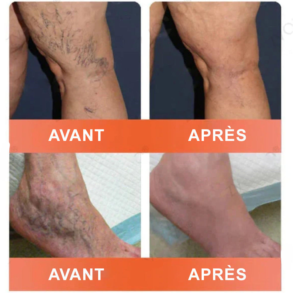 up✅ Patchs de soin à micro-aiguilles Celsiora® Vein Ease – Pour les varicosités, les varices, les gonflements et les jambes fatiguées | Aujourd’hui seulement : -50 %
