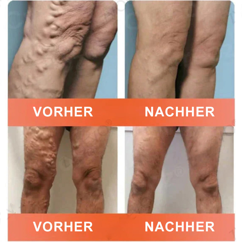 ✅ Celsiora® Vein Ease Microneedle-Pflegepflaster – Bei Besenreisern, Krampfadern, Schwellungen & müden Beinen | Nur heute 50 % Rabatt