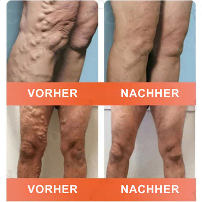 ✅ Celsiora® Vein Ease Microneedle-Pflegepflaster – Bei Besenreisern, Krampfadern, Schwellungen & müden Beinen | Nur heute 50 % Rabatt