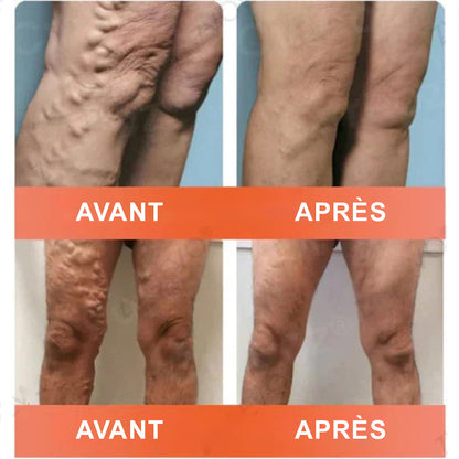 up✅ Patchs de soin à micro-aiguilles Celsiora® Vein Ease – Pour les varicosités, les varices, les gonflements et les jambes fatiguées | Aujourd’hui seulement : -50 %
