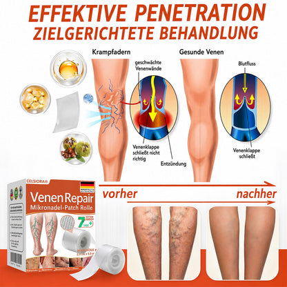 ✅ Celsiora® Vein Ease Microneedle-Pflegepflaster – Bei Besenreisern, Krampfadern, Schwellungen & müden Beinen | Nur heute 50 % Rabatt
